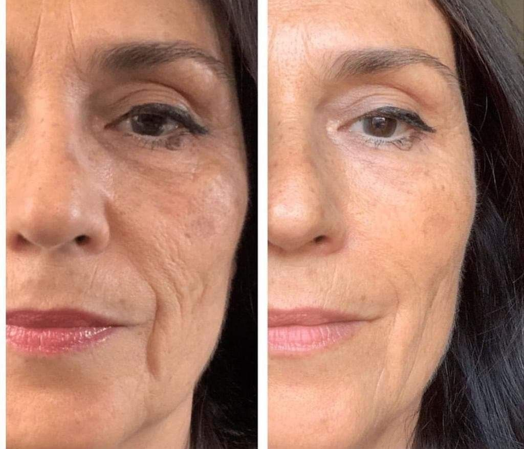 Resultados antes y después