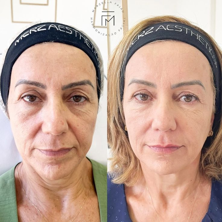 Resultados antes y después