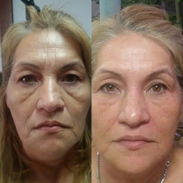 Antes y después